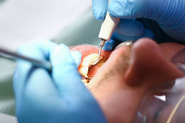 Best Emergency Wisdom Tooth Extraction in New Hartford Center, CT